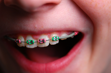 close up of mouth with braces